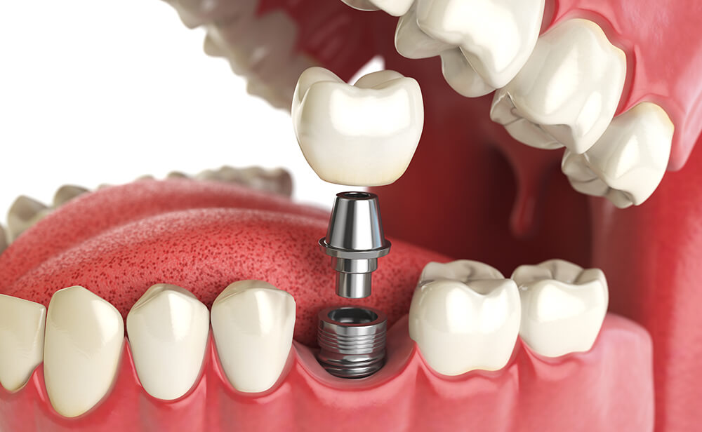 Caring Family Dentistry in Irvine - Nolan Jangaard DDS - Dental Implant